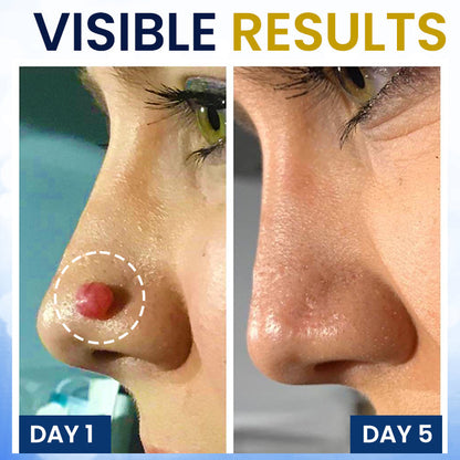 🎁 Ends Today: 70% OFF! 🏆 Virexo™ Skin Tag Cryo Treatment Spray 🧊 — Freezes Away Skin Tags & Warts in Seconds. No Blades, No Pain.